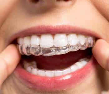 Invisalign braces are clear, comfortable, and removable for normal eating and hygiene. Call Dr. Anirudh Patel in Philadelphia,