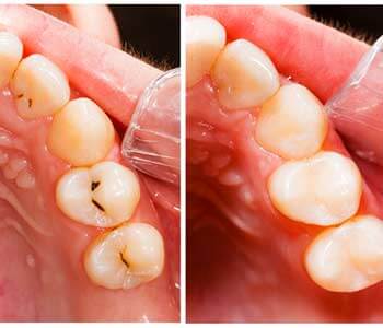 Composite Tooth Filling in Philadelphia PA area Image 2